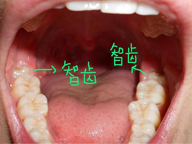 7, 智齿不疼就不用拔?